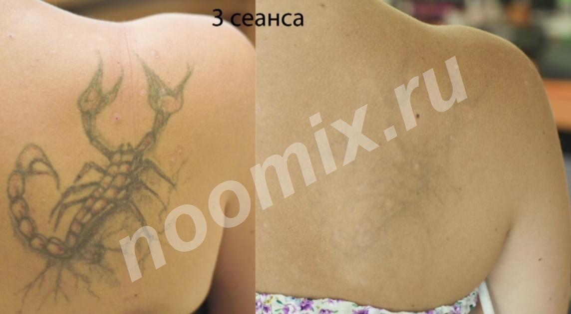 Удаление татуировок татуажа лазером, Республика Тыва