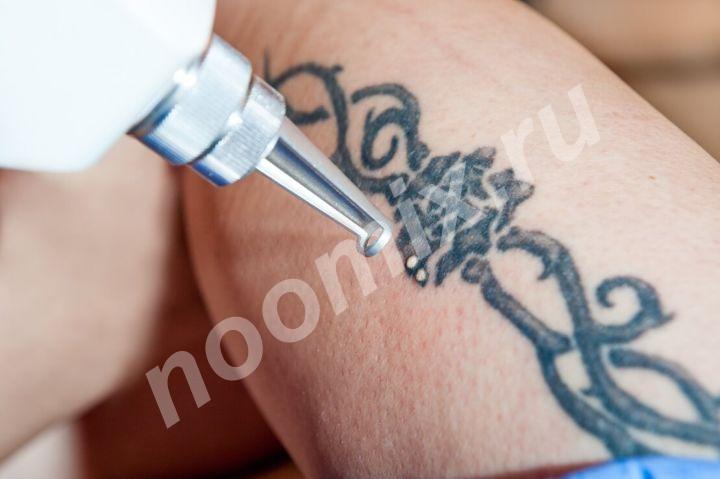 Удаление татуировок неодимовым лазером, Воронежская область
