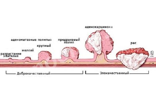 Злокачественное новообразование, образующееся в тканях ..., Чукотский АО